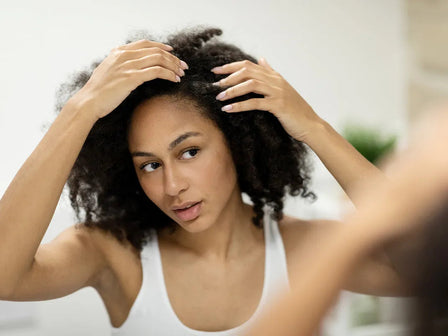 Alopeci prematura