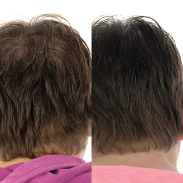 Foligain hårväxtbehandling (kvinnor) Foligain hair growth treatment (women) - Hair Growth Specialist
