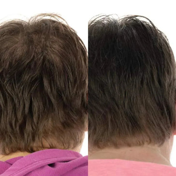 Foligain hårvækstbehandling (kvinder) Foligain hair growth treatment (women) - Hairgivers