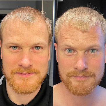 Scandinavian Biolabs traitement pour la croissance des cheveux (hommes) Scandinavian Biolabs hair growth treatment (men) - Hair Growth Specialist