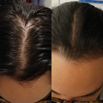 Scandinavian Biolabs hårväxtbehandling (kvinnor) Scandinavian Biolabs hair growth treatment (women) - Hair Growth Specialist