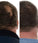 Foligain hair growth treatment (men) - Hair Growth Specialist