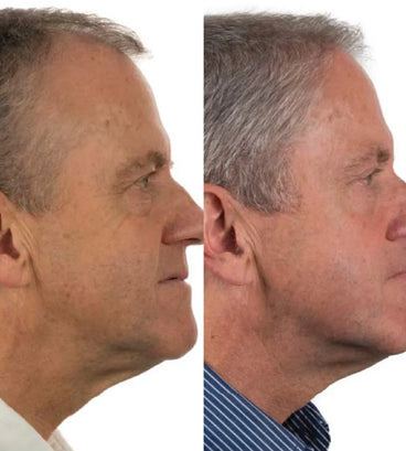Foligain hair growth treatment (men) - Hair Growth Specialist