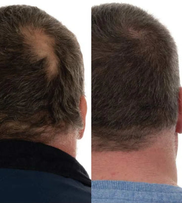 Foligain hair loss shampoo men (473 ml) - Hair Growth Specialist
