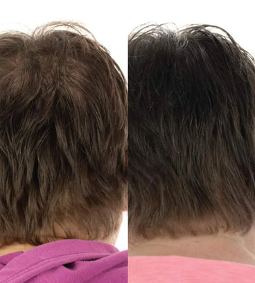 Foligain hair loss shampoo women (236 ml) - Hair Growth Specialist
