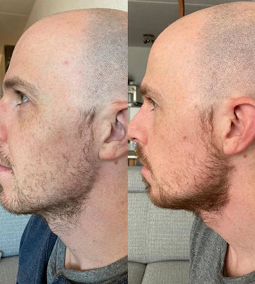 Neofollics beard growth kit - Hair Growth Specialist