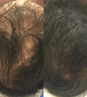 Revita tablets for hair growth (3 months) - Hair Growth Specialist