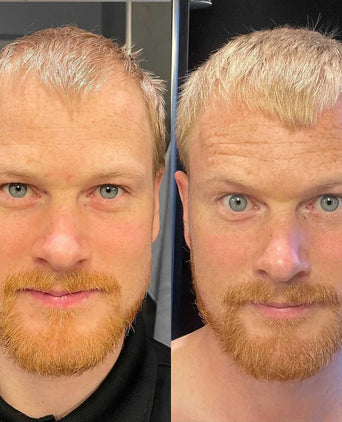 Scandinavian Biolabs hair growth treatment (men) - Hair Growth Specialist