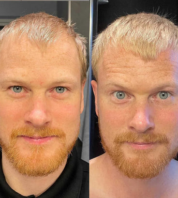 Scandinavian Biolabs hair growth treatment (men) - Hair Growth Specialist