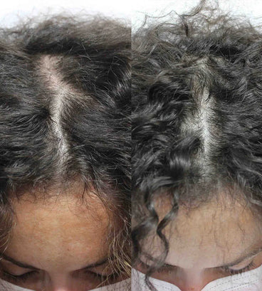 Scandinavian Biolabs hair growth treatment (women) - Hair Growth Specialist