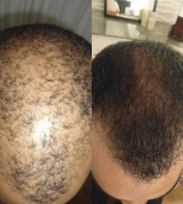 Spectral DNC-N (Nanoxidil) lotion - Hair Growth Specialist