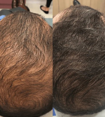 Spectral DNC-N (Nanoxidil) lotion - Hair Growth Specialist
