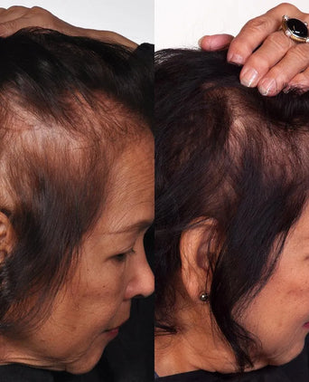 Theradome LH80 PRO laser helmet - Hair Growth Specialist