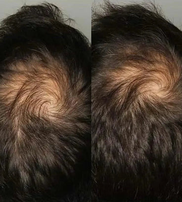 Viviscal hair growth tablets for men (3 months) - Hair Growth Specialist
